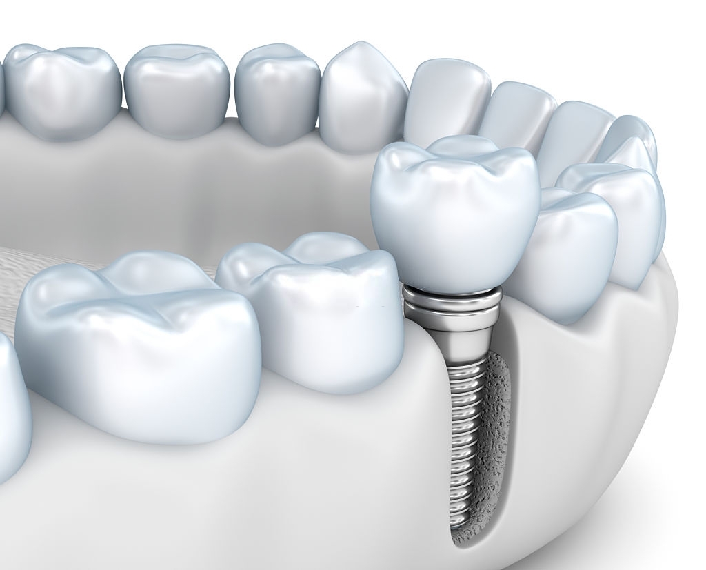 Tips To Increase The Longevity Of Your Dental Implants