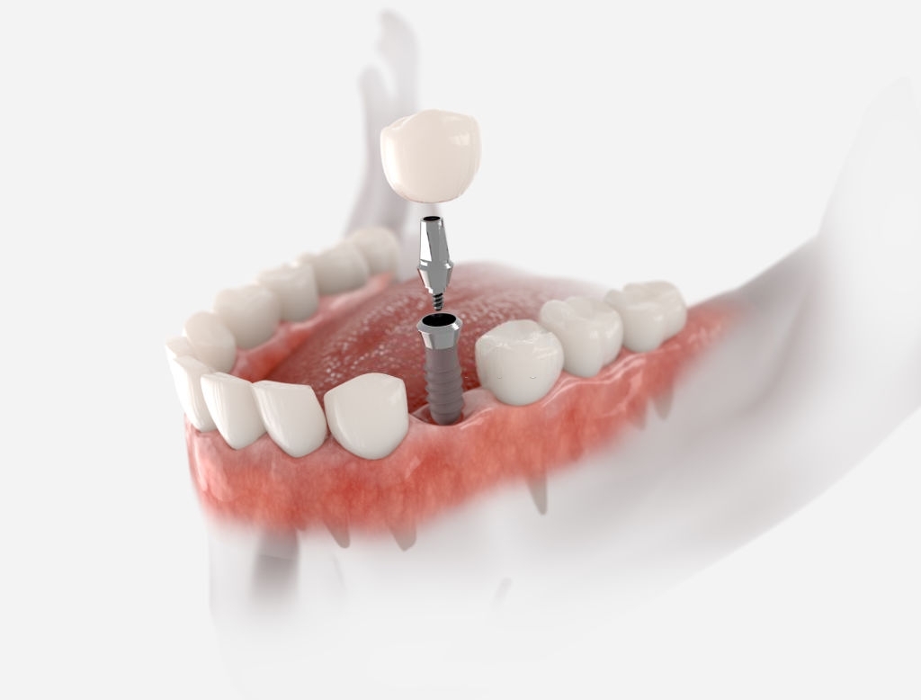 How To Prepare Yourself for a Dental Implant Surgery