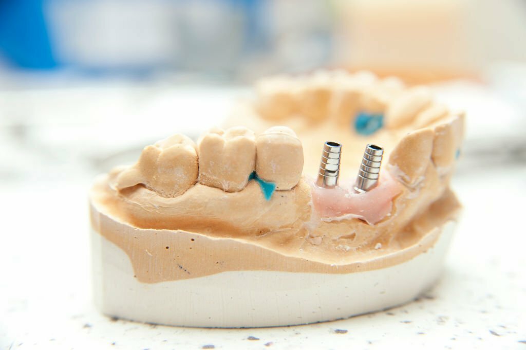 Implants Vs. Dentures: What's The difference?_FI