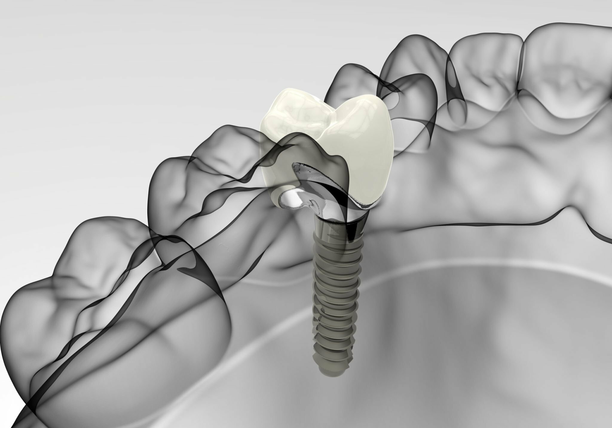 The Impact of Mexico's Dental Implants on Oral Health_FI