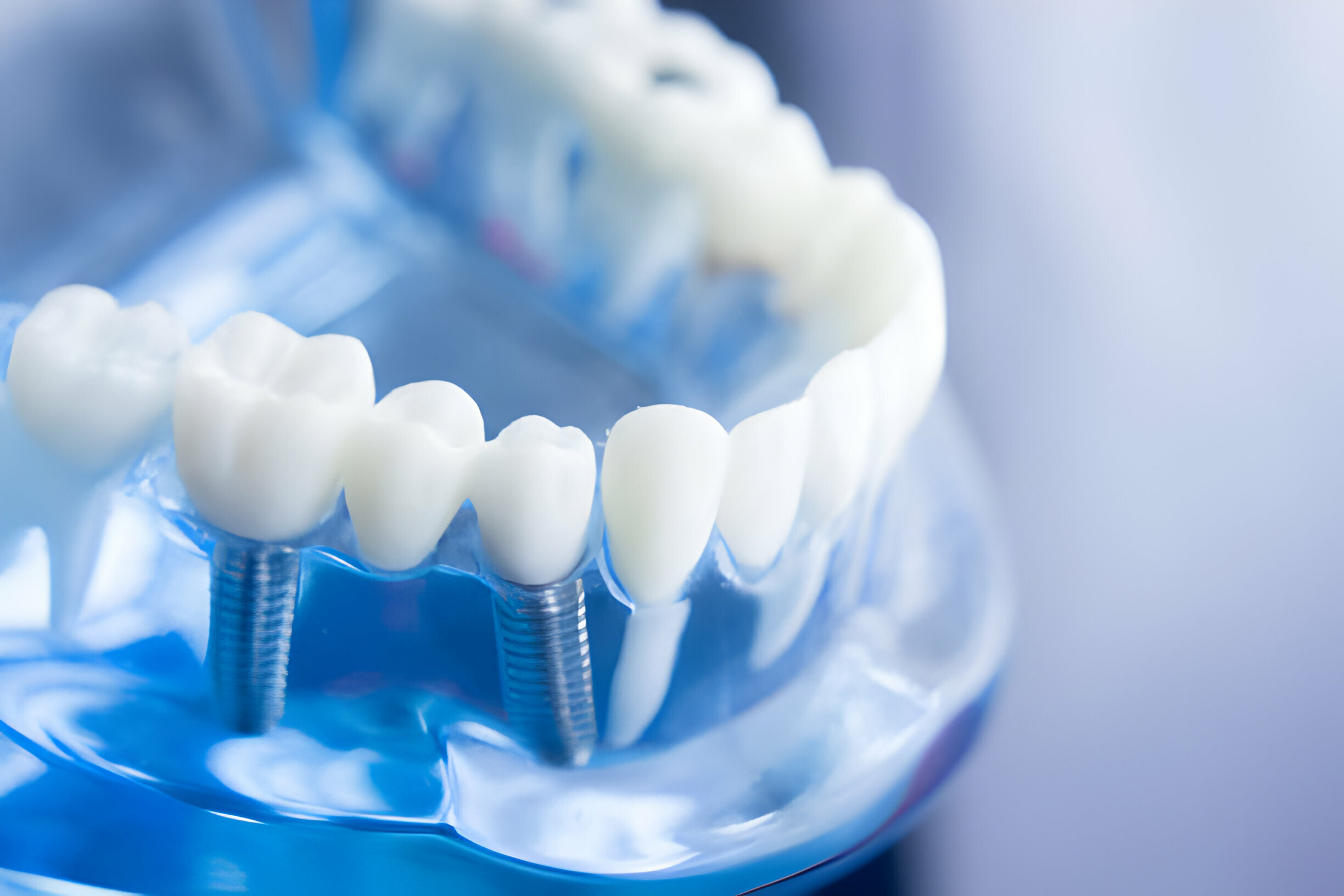 Grants For Teeth Implants: Affordable Options For A Radiant Smile_FI