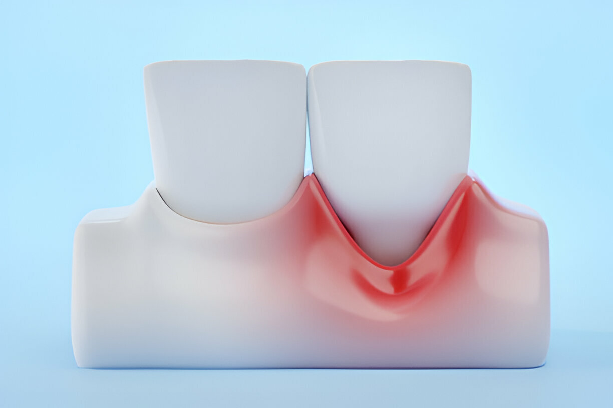 Advanced Gum Disease: Symptoms, Risks, and Treatment Options_FI