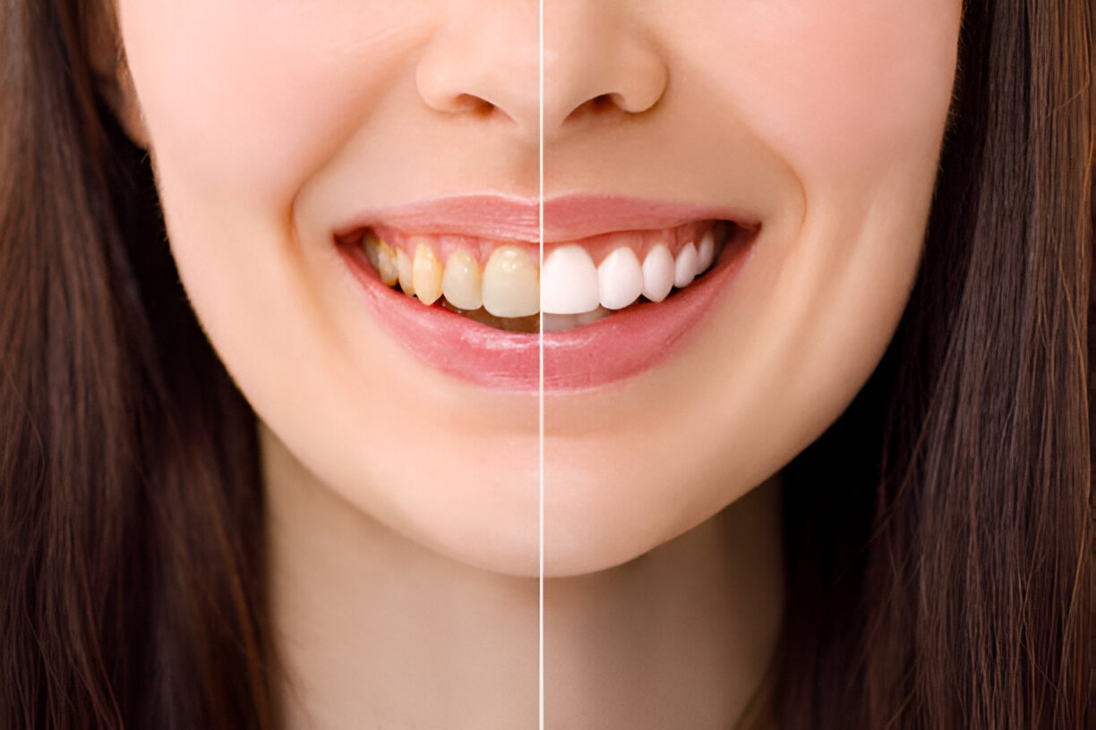 Discover the Secret to a Brighter Smile with Professional Teeth Whitening_FI