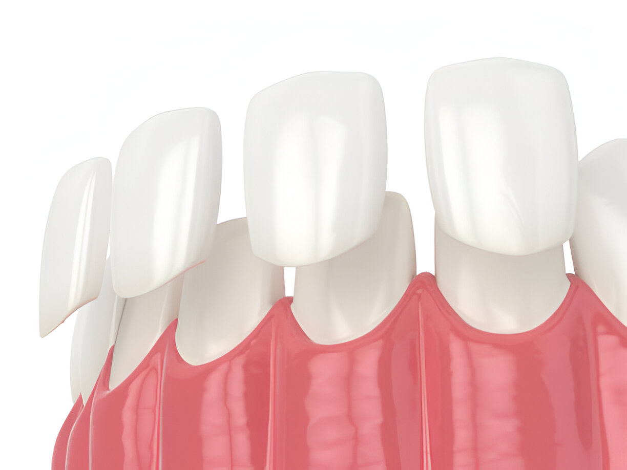 Transform Your Smile with Porcelain Veneers: A Complete Guide_FI