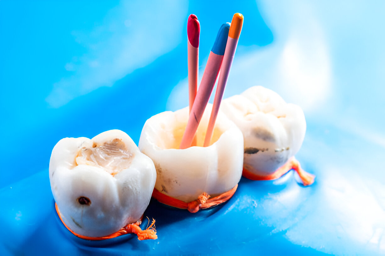 Top Dentist in Bloomfield for Root Canal Procedures: Why Sundance Bloomfield is the Go-To Choice_1