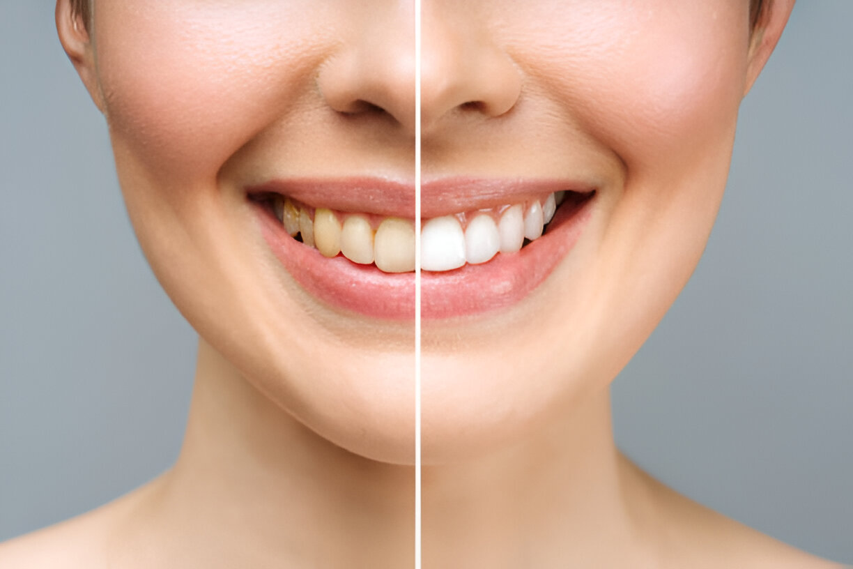 Professional Teeth Whitening in Grants: What to Expect at Sundance Dental_FI