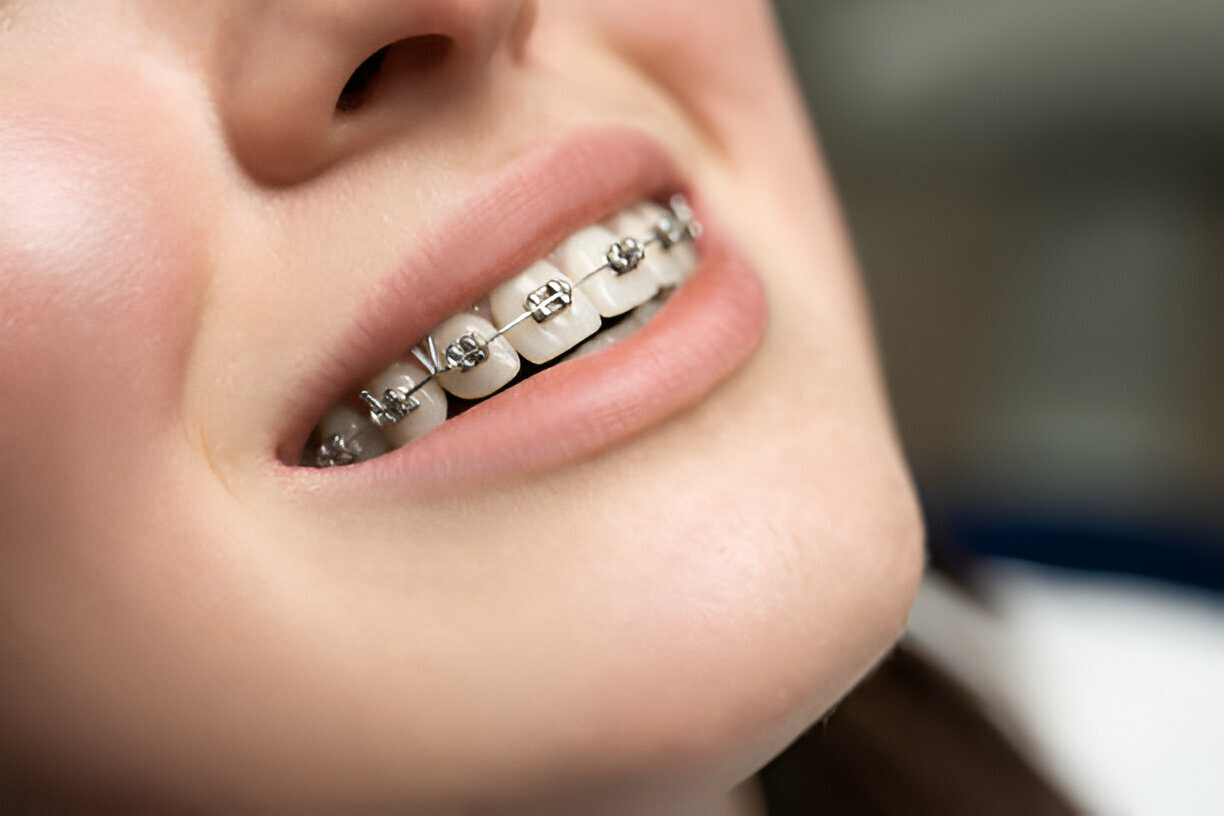 The Comprehensive Guide to Metal Braces at Sundance Dental Bloomfield: Advice from a Trusted Dentist in Bloomfield_FI